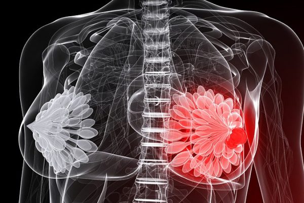 cfarmafotodt_190515_breast_tumor_cancer_800x450